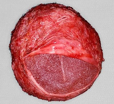 What is Capsular Contracture? What is Capsular Contracture?